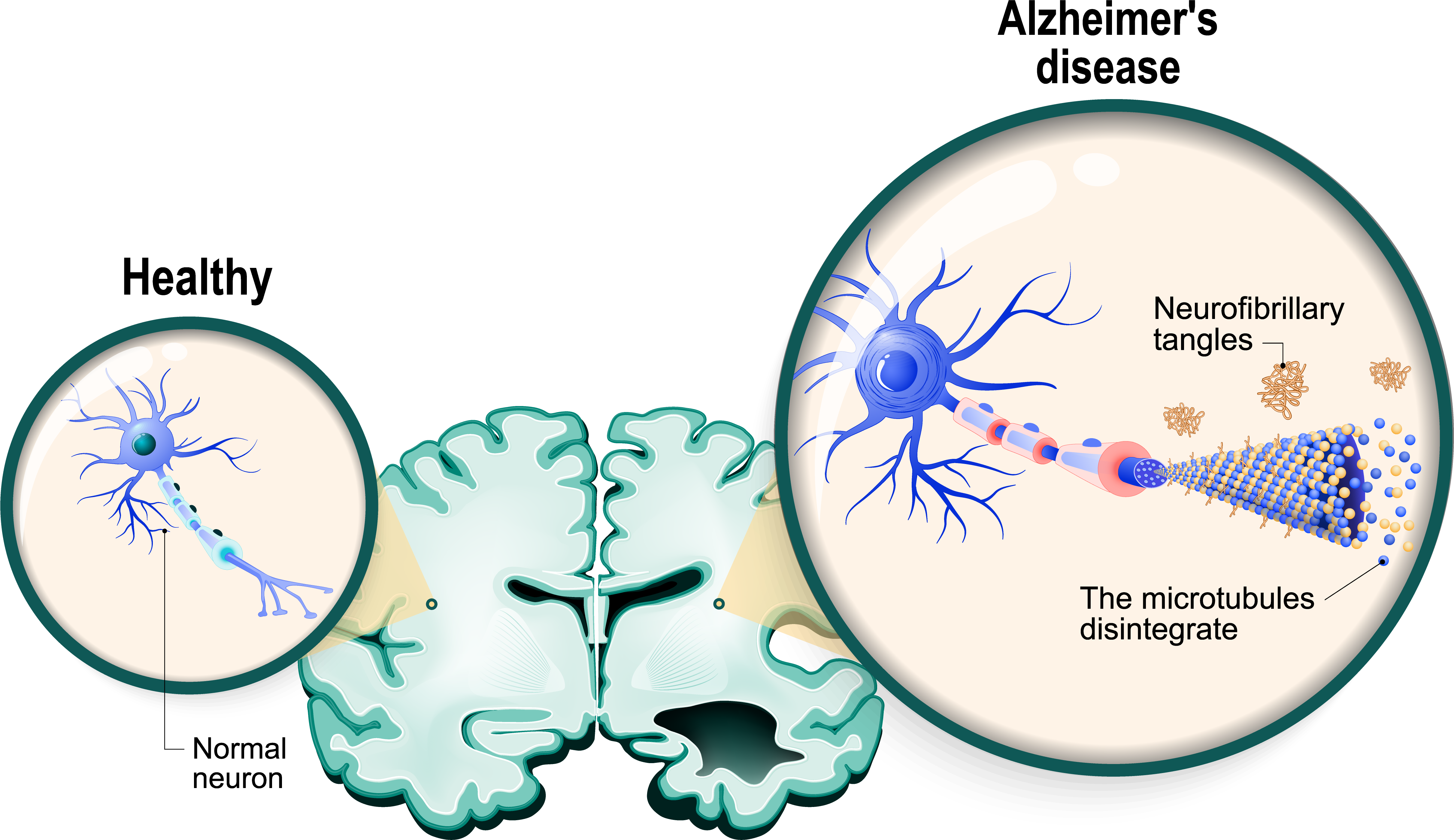 Infographicaccumulationoftauandamyloid